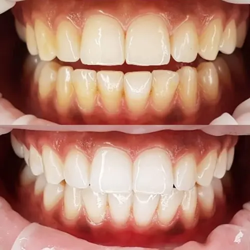 Clareamento Dental - Zenity Odontologia