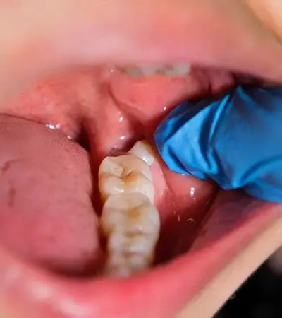 Dr. Jefferson Silva - CROSP 135609 realizando Extração de Siso na Zenity Odontologia Estética