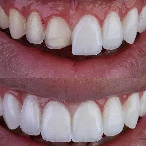 Lente de resina - Zenity Odontologia