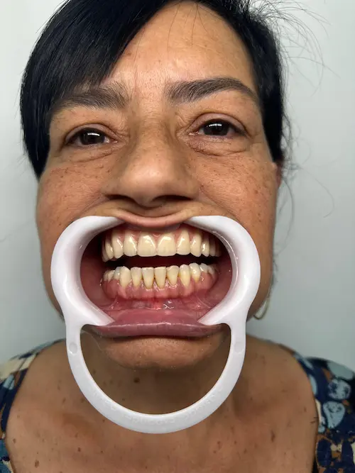 Dr. Jefferson Silva - CROSP 135609 realizando Prótese Dentária na Zenity Odontologia Estética