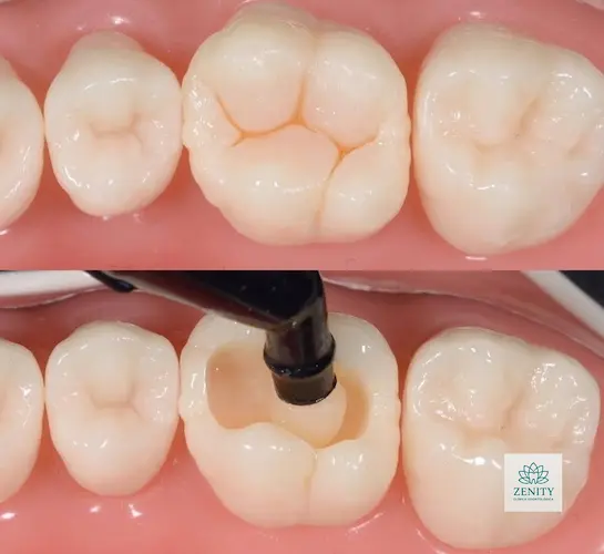 Restauração Clínico Geral - Zenity Odontologia