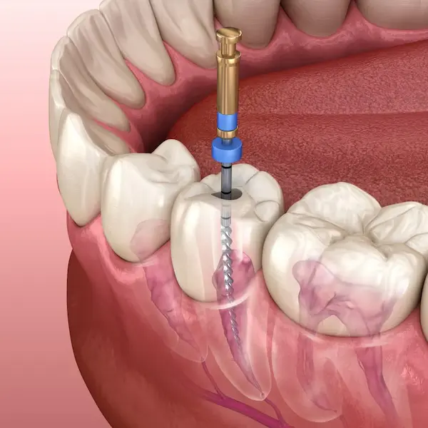 Dr. Jefferson Silva - CROSP 135609 realizando Tratamento de Canal na Zenity Odontologia Estética